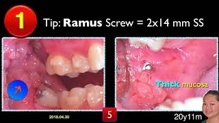 Innovative Impaction Treatment in AAO 2018 Part 5｜【Chris Chang Ortho】CC466 [upl. by Naasah]