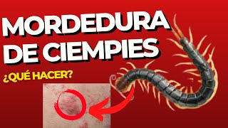 🔴Qué hacer si te muerde un CIEMPIÉS 🔴 Síntomas de mordedura de ciempiés [upl. by Nemhauser355]