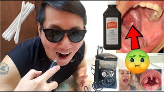 3 Effective Methods Of Getting Rid Of Tonsil Stones amp Bad Breath  How To Get Rid Of Bad Breath [upl. by Leuneb]