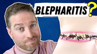 What Is Blepharitis Blepharitis Explained  Best Treatments [upl. by Sucy27]