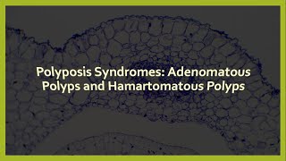 Polyposis Syndromes Adenomatous Polyps and Hamartomatous Polyps [upl. by Kerek739]