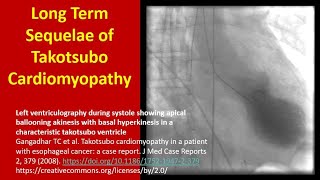 Long Term Sequelae of Takotsubo Cardiomyopathy [upl. by Lesna24]