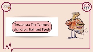 Teratomas Tumours With Eyes Hair and Teeth [upl. by Orson]