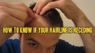 How to Know If Your Hairline is Receding [upl. by Victoir]