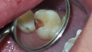 Endodontia Microscópica  dente 16  canal e restauração [upl. by Naldo368]