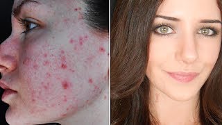 How To Cover Acne amp Scars IF You Want To  Easy Makeup Transformation Routine [upl. by Hgalehs281]