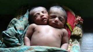 Baby born with two heads in Bangladesh [upl. by Gladdy]