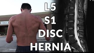 My L5 S1 Disc Hernia Miracle Cure When Physical Therapy Is Just Not Working [upl. by Angle]