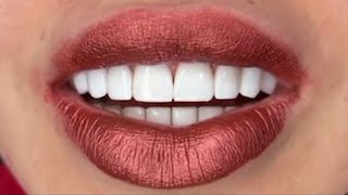 Teeth Whitening ZOOM Review [upl. by Vogele]