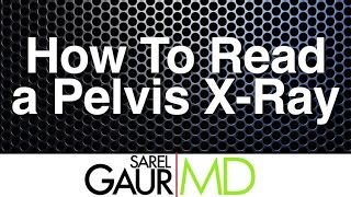 How to Read a Pelvis Xray [upl. by Ahter]