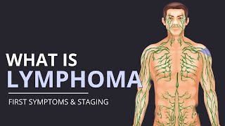 What is Lymphoma First SYMPTOMS and How Its STAGED  The Patient Story [upl. by Aja]