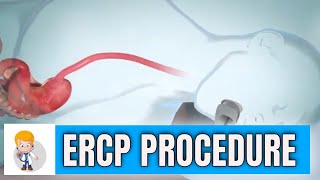 ERCP Endoscopic Retrograde Cholangiopancreatography procedure in 3D [upl. by Ylime]