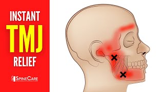 How to Relieve TMJ Pain at Home  30 SECOND RELIEF [upl. by Ajnos435]