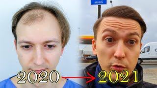 FUE Hair Transplant Growth Timeline  Before amp After [upl. by Esli]