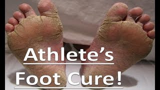 Tea Tree Oil  All Natural Athletes Foot Home Remedy [upl. by Aissak]