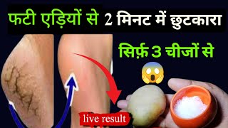 How to heal cracked heels fast  Home remedy for foot dead skin [upl. by Moreland206]