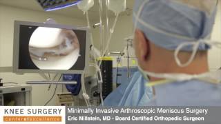 Arthroscopic Knee Surgery  Meniscus Surgery Performed by Dr Millstein [upl. by Nikolos864]