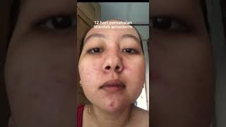 Review Wardah Acnederm Part1 [upl. by Fasta269]