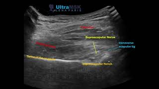 Ultrasound guided Suprascapular nerve block Dr Lena Pari [upl. by Einatirb]