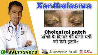 आँखों के कोलेस्ट्रॉल से छुटकारा  xanthelasma  eye cholestrol patch removal home remedies। [upl. by Emogene396]