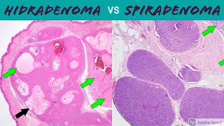 Hidradenoma Acrospiroma vs SpiradenomaCylindroma 5Minute Pathology Pearls [upl. by Naibaf34]