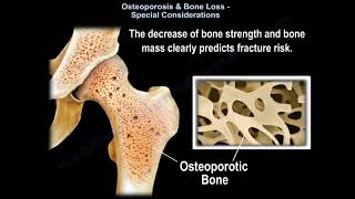 understanding Osteoporosis  Everything You Need To Know  Dr Nabil Ebraheim [upl. by Robi178]