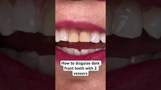 How to disguise discolored front teeth with veneers ❤️ [upl. by Aikaz618]