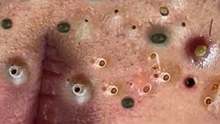 Big Cystic Acne Blackheads Extraction Blackheads amp Milia Whiteheads Removal Pimple Popping  1311 [upl. by Oletta]