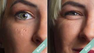 How to Cover Acne Scars with a Hollywood Secret [upl. by Ojeillib]