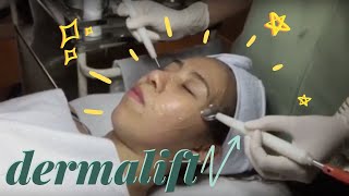 Dermalift Treatment [upl. by Addie]