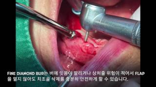 Bur selection tip For alveolopasty and osteoplasty by 드림팩토리치과 [upl. by Eelsel346]