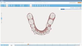 UPPER AND LOWER MOLAR DISTALIZATION [upl. by Madelina525]