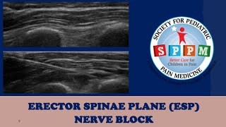 Erector Spinae Plane ESP Nerve Block [upl. by Pappas]