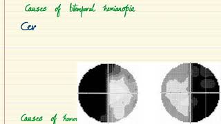 Ocular signs  Bitemporal Hemianopia and Homonymous Hemianopia [upl. by Yllac]