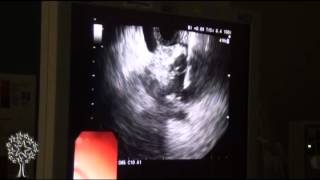 Endoscopic Ultrasound [upl. by Uhej]