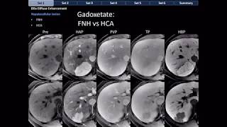 CT Differential Diagnosis of Focal Hepatic Lesions Basic Radiology [upl. by Tchao]