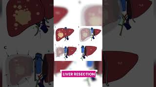 Exploring Treatment Options for Liver Cancer  Dr Pallavi Redhu livercancer cancer treatment [upl. by Billye]