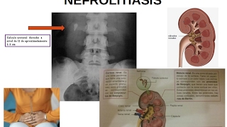 FISIOPATOLOGÍA URINARIA Litiasis renal o nefrolitiasis piedras en el riñón [upl. by Nanete204]