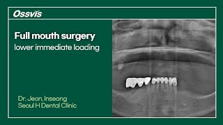 Clinical Case Full mouth surgery lower immediate loading [upl. by Tomchay]