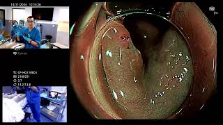 Evaluation amp treatment of colon polyp [upl. by Seagrave]