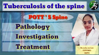 Tuberculosis of the spine  POTTS SPINE  pathology diagnosis examination treatment [upl. by Ocirrej]