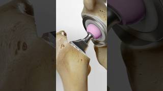 Total hip replacement explained 3D Animation [upl. by Roice823]