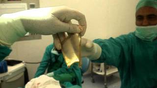 How to take a Split Thickness Skin Graft [upl. by Lebiralc]