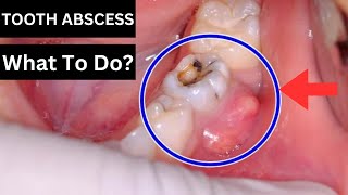 How To Treat A Tooth Abscess [upl. by Enimsay]