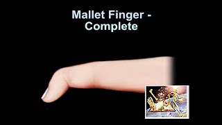 Mallet Finger Complete  Everything You Need To Know  Dr Nabil Ebraheim [upl. by Analahs]