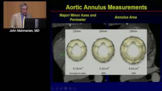 Essential Imaging for TAVR Annulus Arch and Access John Mahmarian MD April 30 2016 [upl. by Reniti]