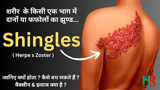 shingles disease symptoms causes treatment and vaccine information in hindi [upl. by Rozalie]