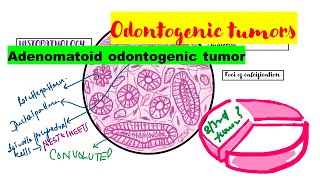 Adenomatoid odontogenic tumor HISTOPATHOLOGYradiographic featuresclinical featuresTreatment [upl. by Lissy]