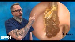 HOW TO SAFELY REMOVE A HUGE EAR WAX PLUG Earwax removal  EP991 [upl. by Henryetta]