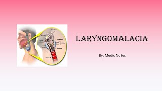 Laryngomalacia  etiology signs amp symptoms investigation treatment [upl. by Aserehs]